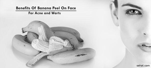 Does Eating Bananas Cause Acne? image 0
